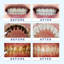 Load image into Gallery viewer, Electric Toothbrush Dental Calculus Remover Kit